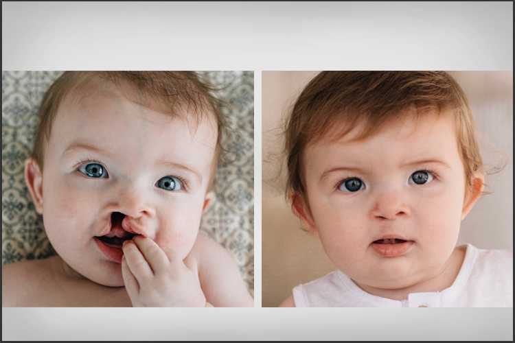 Cleft Lip Cleft Palate Craniofacial Surgery CAMC